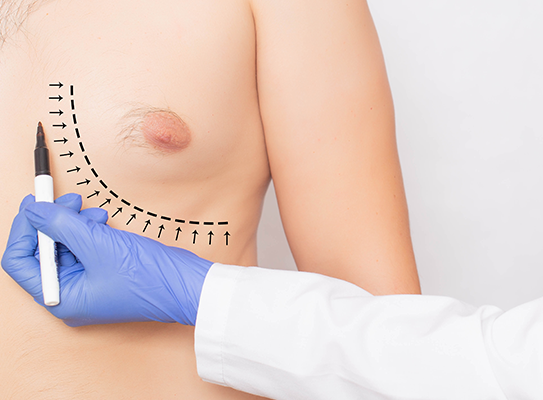 Gynekomasti hos Specialistläkarna i Trollhättan