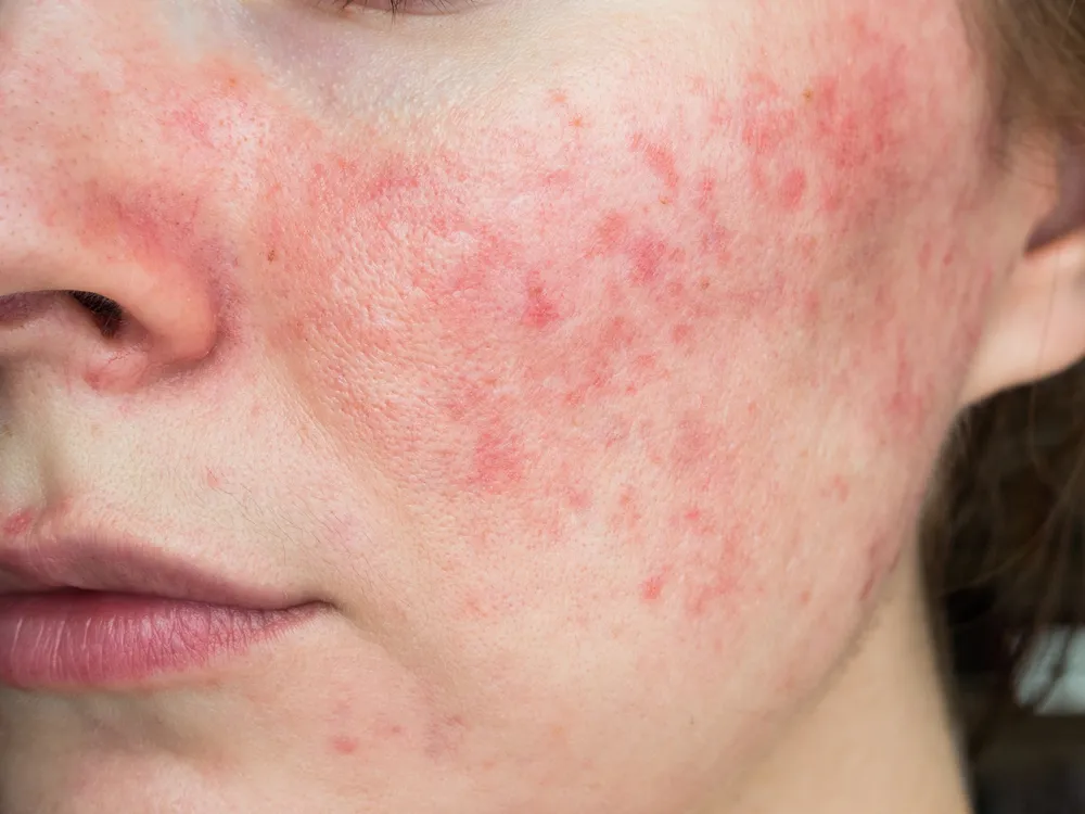 Hudvård och behandling av akne och rosacea hos Specialistläkarna